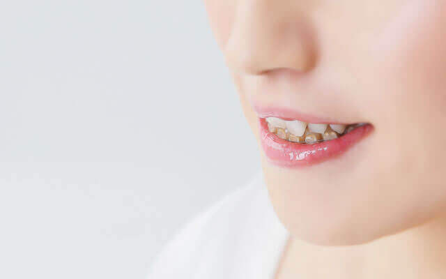 治療期間が短い歯科矯正用アンカースクリューを使用した矯正歯科治療